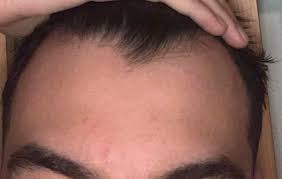 I am going to take part in it. Hair Seems To Be Thinning A Little Especially In The Front And My Hairline Is Receding A Bit I Think And Help Or Tips Malegrooming