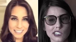 Woman whose face was paralyzed by stroke has smile rebuilt with thigh  muscle