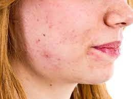 Februar 2020 wir erklären, wie sie entstehen und geben acht ultimative tipps, wie sie die lästigen pickelmale schnell wieder loswerden #pickel #pickelmale #beauty #tricks #tipps #hausmittel #soforthilfe #narben #gesundheit #glamour #glamourgermany Aknenarben Behandeln Diese Tipps Helfen Dir Wirklich Wunderweib