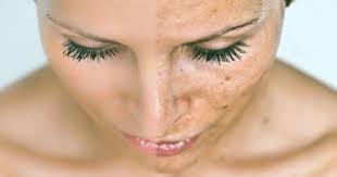 Flek hitam di wajah terutama area pipi memang akan menjadi gangguan bagi kemulusan wajah anda. 11 Cara Menghilangkan Flek Hitam Dengan Bahan Alami Yang Ampuh