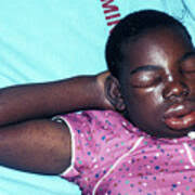 Bee Sting Reaction Photograph by Science Photo Library