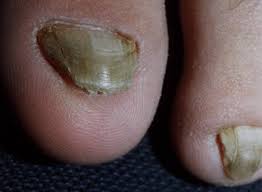 Image result for Yellow nail syndrome feet