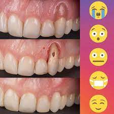 Correcting A Gum Recession Removal Of Old Pink Composite Endo Retreatment Glass Ionomer Cement To Cover Perforatio Gum Recession Tooth Repair Dental Posters