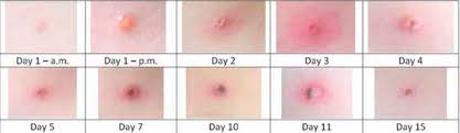 Cara Hilangkan Parut Chicken Pox Dengan Cepat