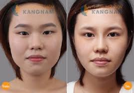 Kết quả hình ảnh cho bấm mí hàn quốc