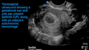 Image result for First Trimester Ultrasound