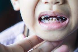 Check spelling or type a new query. Tooth Decay In Children Causes Treatment Prevention