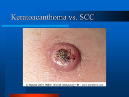When malignant cancer cells form and grow within a person's breast tissue, breast cancer occurs. Nonmelanoma Skin Tumor Ppt Video Online Download