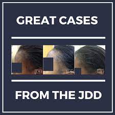 These injections are repeated about every four to six weeks and are usually given by a dermatologist. Intralesional Triamcinolone Acetonide In The Treatment Of Traction Alopecia Next Steps In Dermatology