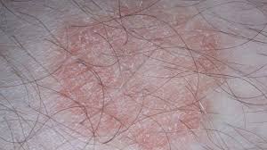 Check spelling or type a new query. Ringworm Symptoms Pictures Treatment Diagnosis More