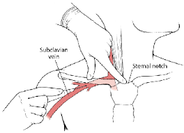 Arterial trauma during central venous catheter insertion: Central Venous Catheterization Heart And Blood Vessel Disorders Msd Manual Consumer Version