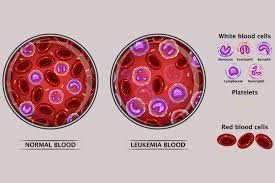 There are three main types of blood cancers: 9 Symptoms Of Leukemia In Teenagers And Its Treatment