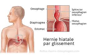 Consommer du vinaigre de cidre aide à seules les personnes souffrant d'une gastrite (inflammation de l'estomac), de reflux. Hernie Hiatale Description Symptomes Complications Causes Traitement Reflux Gastro Oesophagien Reflux Gastrique