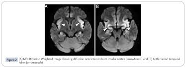 Encephalitis in the immunocompromised host. Herpes Simplex Virus Encephalitis In A Healthy Lady Insight Medical Publishing