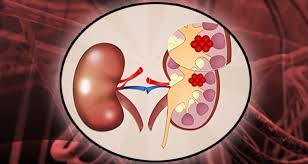 The changes tell the cells to grow and divide rapidly. Kidney Cancer Causes 11 Factors Putting You At Risk