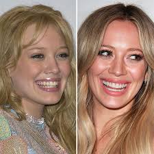 Anthony mobasser explains veneers vs lumineers to help you determine which is best for you! Real Stars Fake Teeth 20 Celebrities Who Have Had Cosmetic Dentistry More