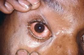 Gonorrhea Practice Essentials Background Pathophysiology