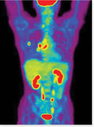 How do you prepare for a pet scan? Pet Ct Scan Cancer Detection Ct Scan Machine