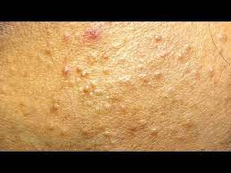 Relax Every Day With Sac Dep Spa 0043 Youtube In 2021 Pimple Popping Spa Relax