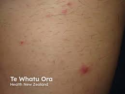 Image result for scabies bite