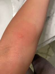 Image result for mite bites on humans