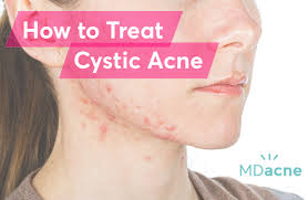 10 best acne products for sensitive skin + 6 essential sensitive… this product is one of the best choices for cystic acnewhen it comes to sensitive skin. What Is The Best Treatment For Cystic Acne Mdacne