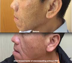 Then when your skin has calmed down, maybe rethink your routine a bit: Micro Needling Pasadena Tx Dermatologist