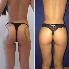 The procedure includes liposuction of fat from somewhere on your body where you don't want it (typically the stomach and sides). 5 Countries To Get Affordable Brazilian Butt Lift Compare Prices Bookimed