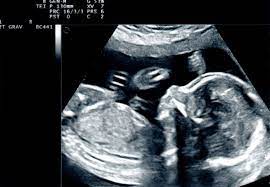 Maybe you would like to learn more about one of these? Tanda Janin Bergerak Ini Usia Kehamilan Si Kecil Mulai Bergerak Semua Halaman Nakita
