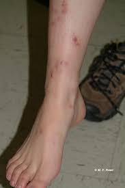 I did hit my foot on the bottom of a table around when it appeared but i can't remember if it was even in the same spot. Mystery Bites Insect And Non Insect Causes Entomology