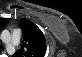 And of the 70 million scans done last year — double the number a decade clinical trials like the one smith and her husband volunteered for are part of an effort that began in the early 1990s to. Breast Lesions Incidentally Detected With Ct What The General Radiologist Needs To Know Radiographics