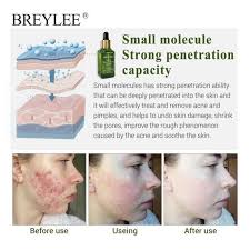 Promo Breylee Acne Set