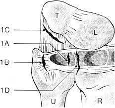 Palmer classification for triangular fibrocartilage complex (tfcc) abnormalities is based on the cause, location, and degree of injury 1: A Method For All Inside Arthroscopic Repair Of Palmer 1b Triangular Fibrocartilage Complex Tears Arthroscopy