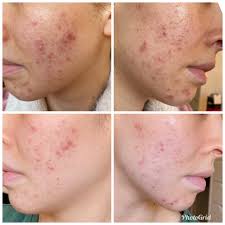 5 days of using the Dr Dennis Gross Spectralite Faceware Pro mask (At home  LED light therapy treatment mask for acne). : r/AusSkincare