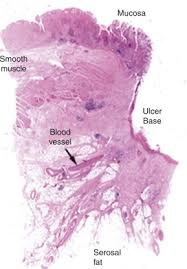 Peptic Ulcer Disease Sciencedirect