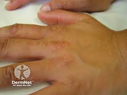 Image result for pruritic urticarial papules and plaques of pregnancy