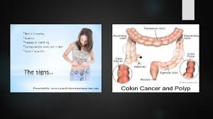 Colorectal cancers are what colon cancer and rectal cancer are typically referred to when discussed together. Colon Cancer What Is Colon Cancer Cancer That