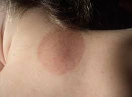 Remedies For Neck Rashes Lovetoknow Yeast Infection Treatment Yeast Infection Toxic Mold