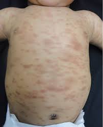 Image result for Urticaria pigmentosa children