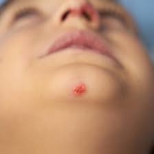 Image result for red rash face