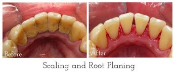 Maybe you would like to learn more about one of these? Cara Mengatasi Gigi Ngilu Setelah Scaling Membersihkan Karang Gigi