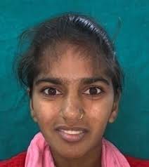 ENHANCING ESTHETICS WITH METAL -FREE PROSTHESIS