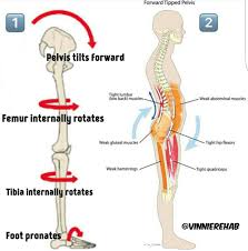 Is it nerve, muscle, or joint? In The Picture Above You Can See In 1 How An Anterior Tilt Of The Pelvis Will Affect The Joints And Basically Interna Yoga Anatomy Hip Flexor Muscle Imbalance