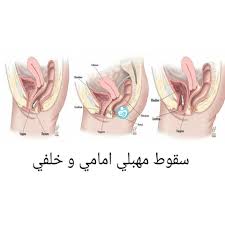 إصلاح السقوط المهبلي - Dr. Wael Elbanna - د. وائل البنا