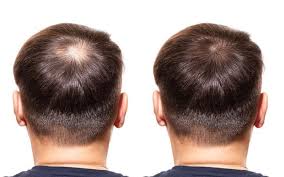 Finasteride and minoxidil (for men) and minoxidil (for women) have the best level of evidence for medicines used to treat inherited hair loss. The Best Dht Blockers How They Can Combat Hair Loss Skinkraft