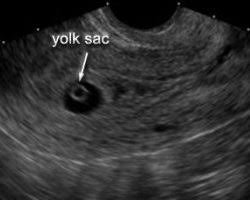 first trimester scans weeks 4 5 6 week by week early