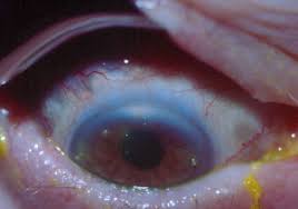 Image result for lesion sclera