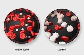 Blood cancer can be hard to spot. Leukemia Types Symptoms Stages Causes Diagnosis Treatment Survival Rate
