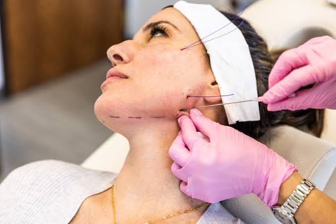 Thread lifts. 11 benefits of facial threading - Hush LA Medspa
