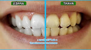 Mouiller sa brosse à dents, la tremper dans le mélange et se brosser les dents pendant 3 minutes. Blanchiment Dentaire Oujda Prix Ou Blanchir Dents Recette Maison Specialiste Depuis 1999